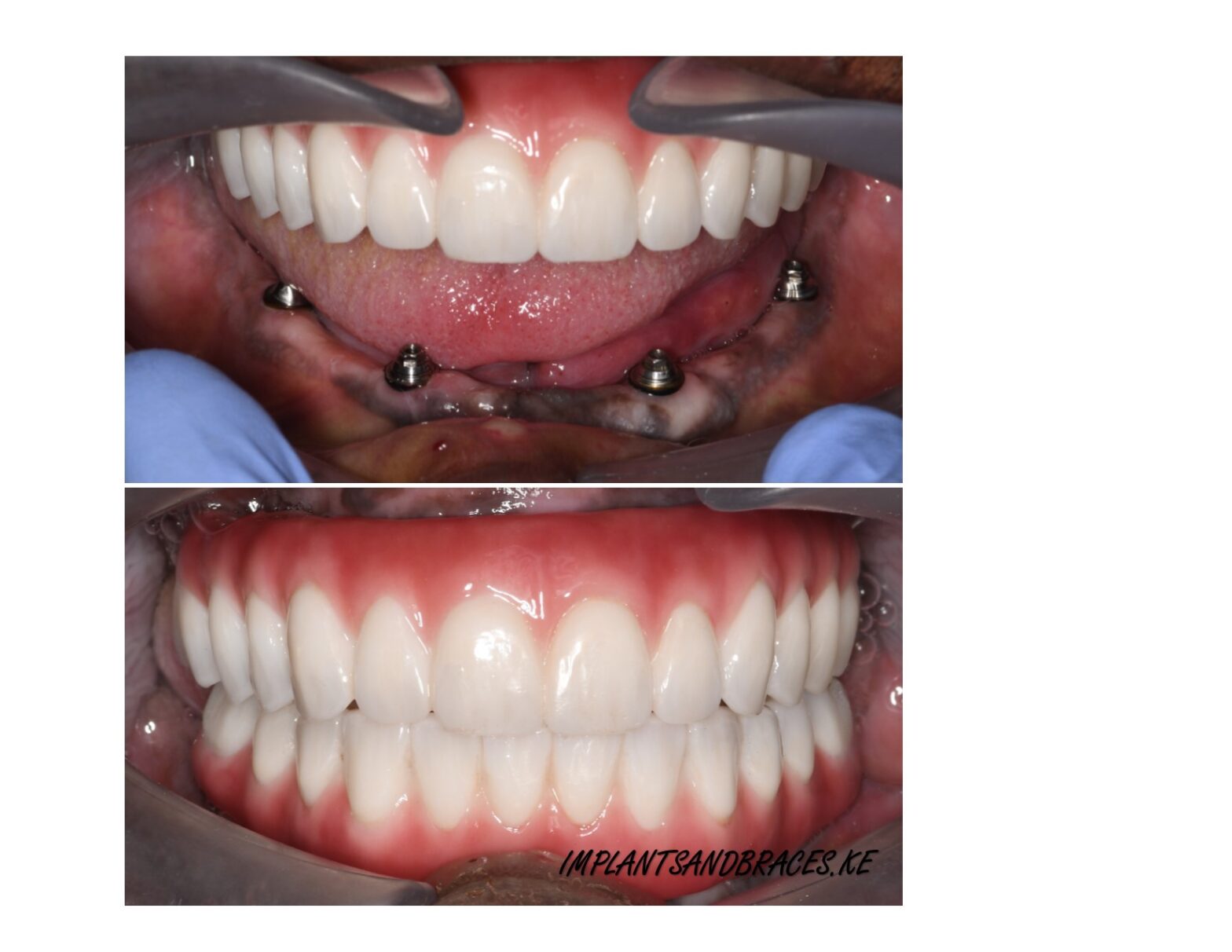 full arch implant on all fours lower jaw