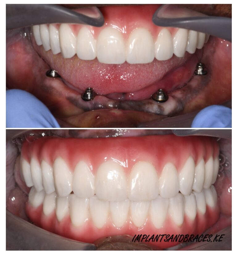 full arch implant on all fours lower jaw