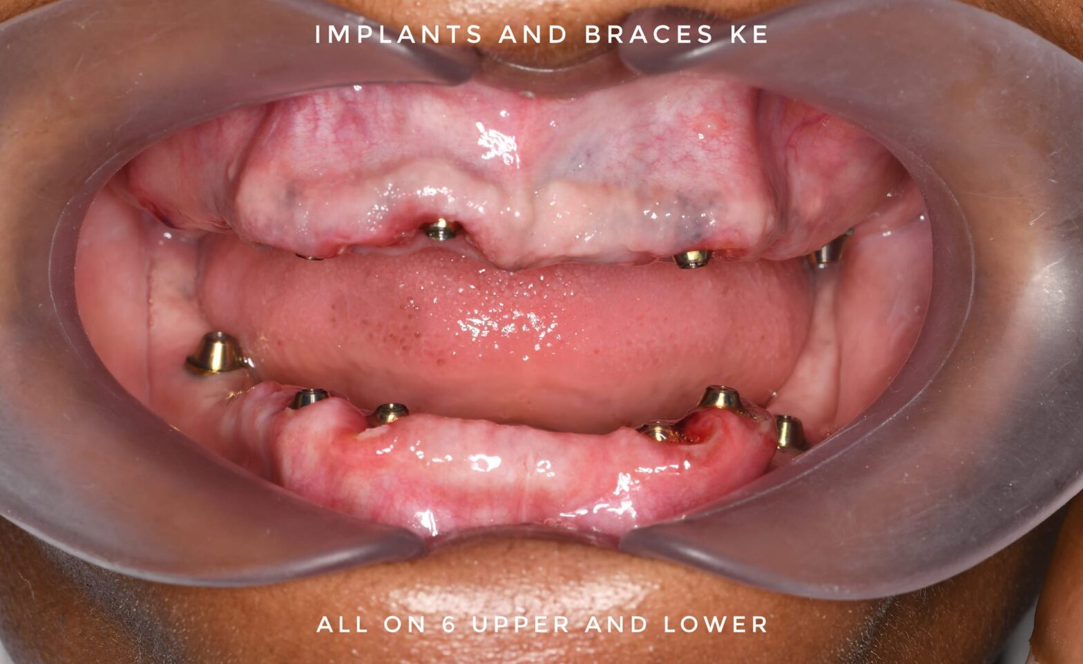 missing teeth all on 4 dental implants