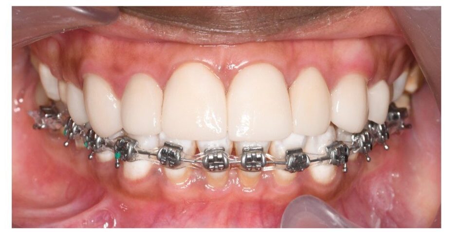 How Much Do Metal Braces Cost in Kenya: Cost of Dental Braces In Nairobi,  Kenya
