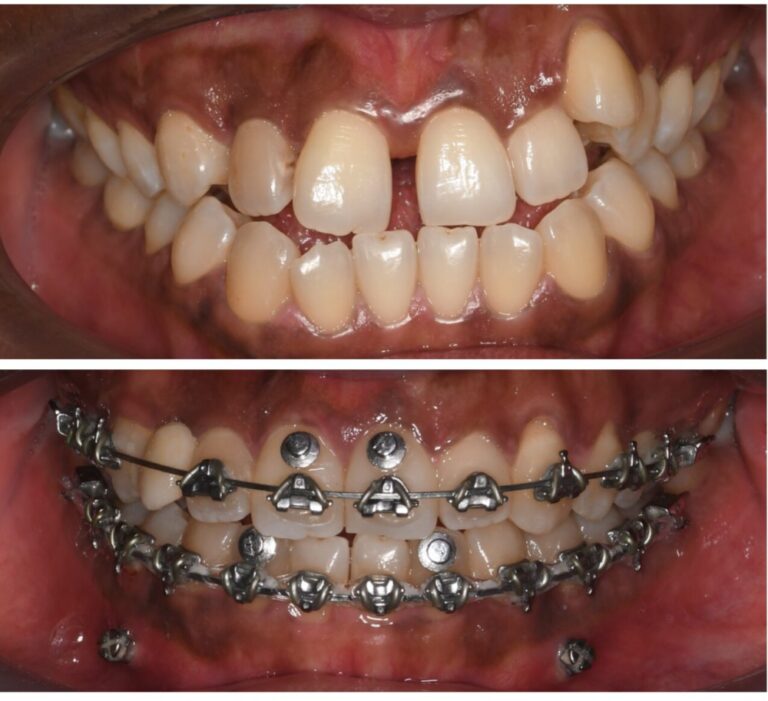 braces on both jaws