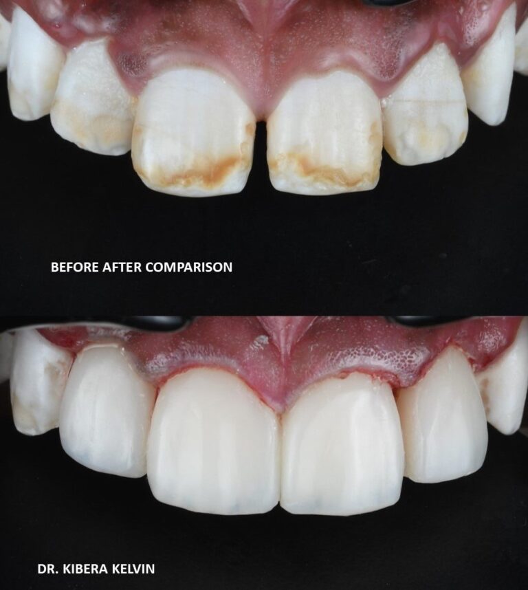 Direct Veneers/ Dental Masking