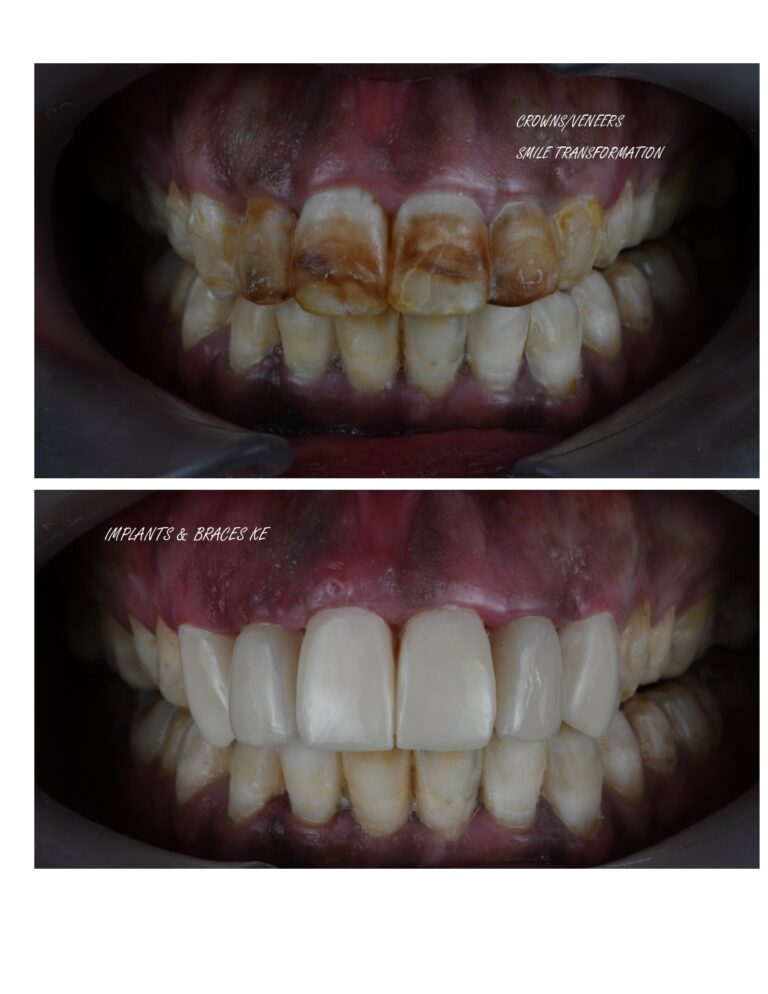 Dental Crowns Vs Veneers