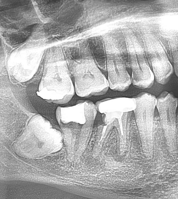 OPG X RAY image of Impacted tooth